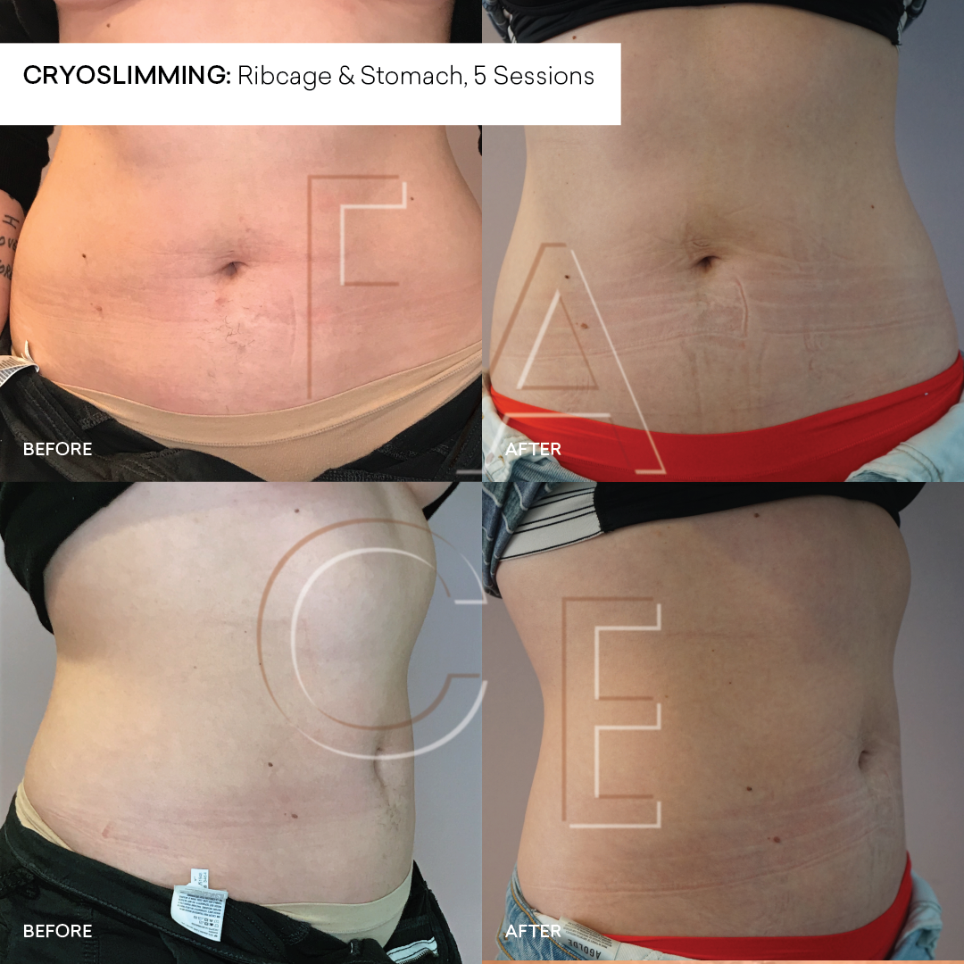 Cryoskin / Body Contouring